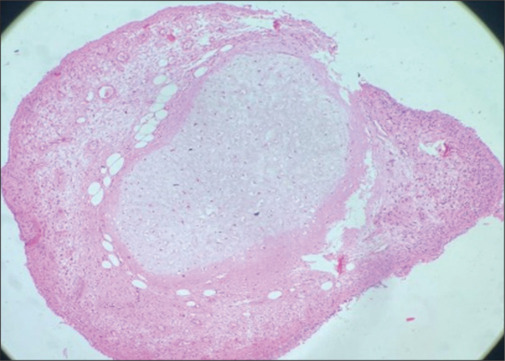 Bronchoscopic management of endobronchial hamartomas using "hot and cold" therapies - Initial experience in two patients.