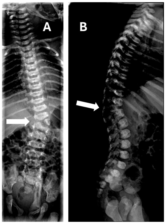 Long-Term Outcomes of Prenatally Diagnosed Fetal Hemivertebra: A 15-Year Single-Center Review.