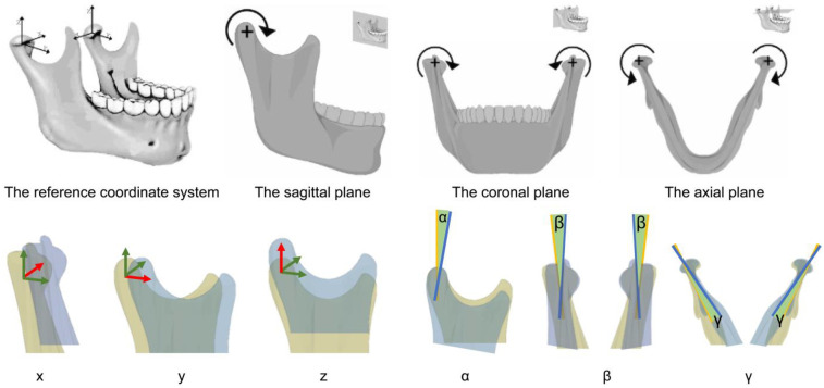 Machine learning-based assessment of condylar changes after orthognathic surgery of asymmetric dentofacial deformities.
