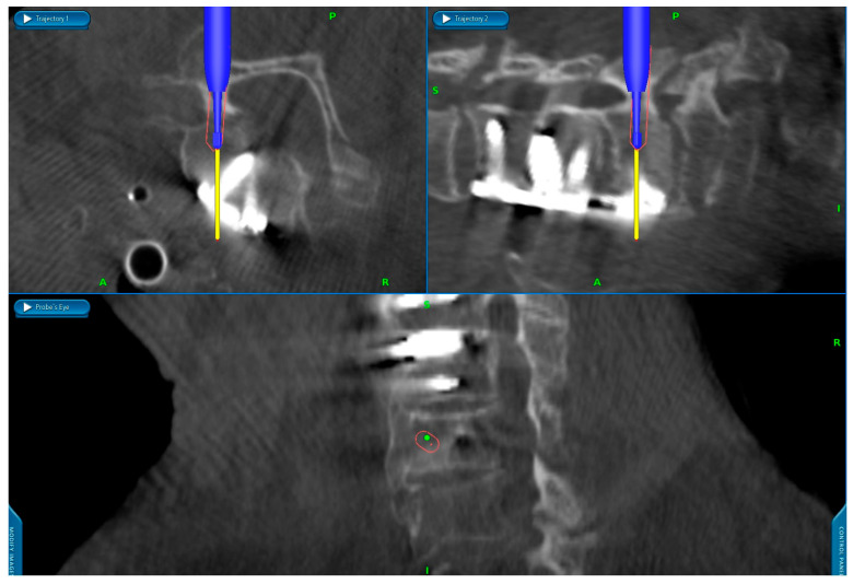 Accuracy of Navigated High-Speed Drill-Assisted Cervical and Upper Thoracic Pedicle Screw Placement-A Single Center Experience with 1112 Pedicle Screws.