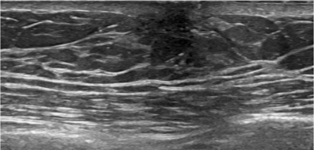 A rare incidence of pseudoangiomatous stromal hyperplasia (PASH) in a senior adult male: a case report highlighting a novel presentation.