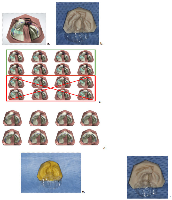 Expanding Access to Presurgical Cleft Care: Digital Nasoalveolar Molding with Clear Aligners in a Rural Low-Income Population.