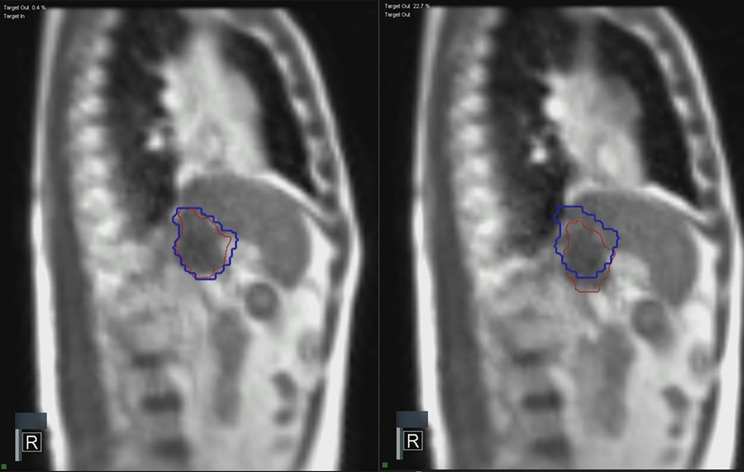 Magnetic resonance imaging-guided radiotherapy for portal vein tumor thrombus in hepatocellular carcinoma: outcomes and prognostic factors.
