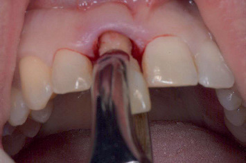 Fully Guided Implant Placement and Immediate Provisionalization in the Maxillary Aesthetic Zone Using Prefabricated Restorations.