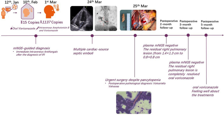 "Mushroom in the heart": a <i>Volvariella volvacea</i> infective endocarditis case report.