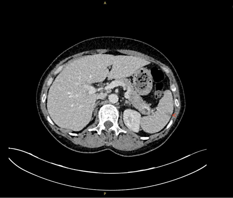 Mononeuritis Multiplex as a Diagnostic Challenge in Eosinophilic Granulomatosis With Polyangiitis: Implications of Early Versus Delayed Recognition.