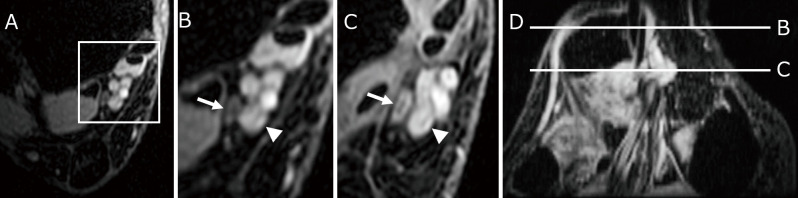 Preoperative Magnetic Resonance Imaging Findings in Patients with Tarsal Tunnel Syndrome and Postoperative Outcomes.