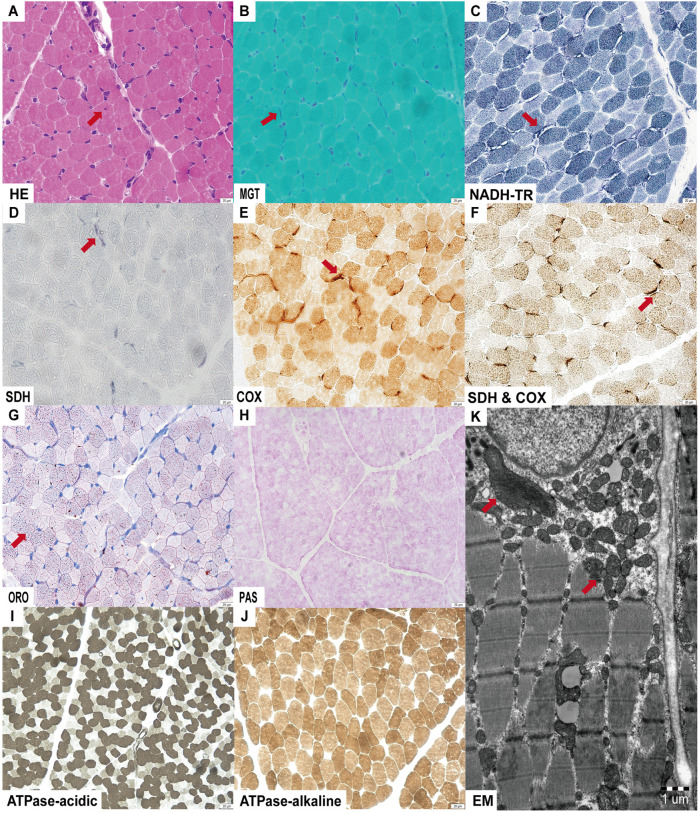 Case Report: Biallelic variants in <i>MRPS36</i>, encoding a component of the 2-oxoglutarate dehydrogenase complex, cause leigh syndrome.