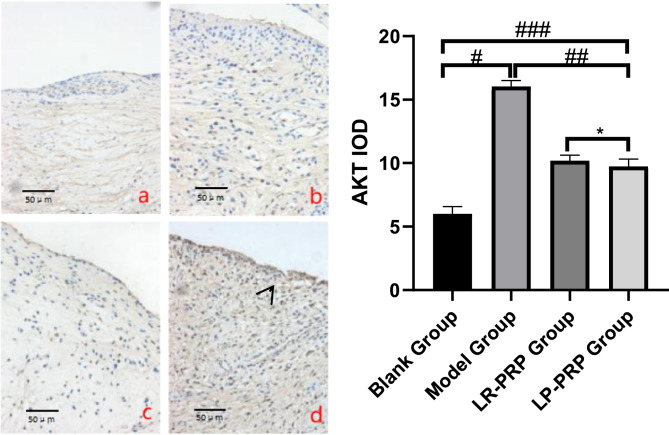 Comparison of the therapeutic efficacy of leukocyte-poor and leukocyte-rich platelet-rich plasma in rabbit knee osteoarthritis and the study of autophagy mechanism.
