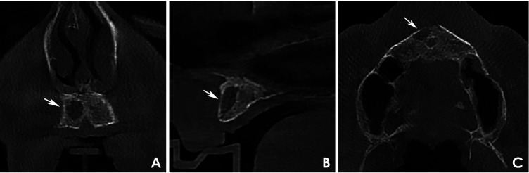 Cone-beam computed tomography-based analysis of jawbone destruction patterns in multiple myeloma: Associations with clinical data in an observational study.