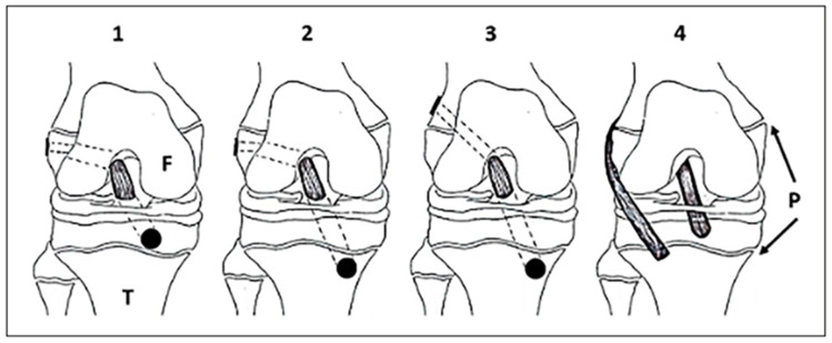 Skeletal Maturity Assessment in Pediatric ACL-Reconstruction.