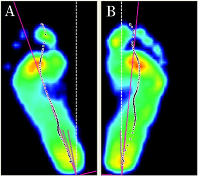 Foot progression angle asymmetry as a potential biomechanical marker of radiographic severity in knee osteoarthritis.