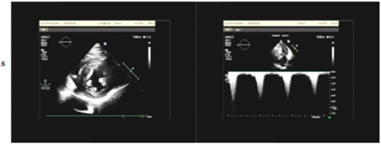 Case Report: Transient hypertension and myalgia following mavacamten therapy in a patient with hypertrophic obstructive cardiomyopathy.