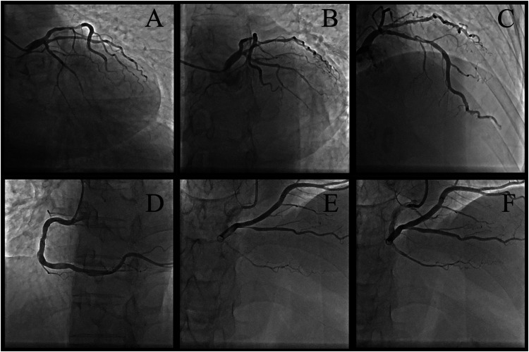 Case Report: Coronary plaque rupture following glucocorticoid tapering in a high-risk CAD patient with immune nephritis: mechanistic insights and clinical implications.