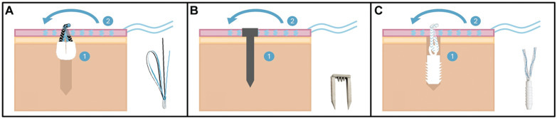 Onlay Fixation With an All-Suture Anchor Provides Sufficient Biomechanical Stability for Lateral Extra-articular Tenodesis.