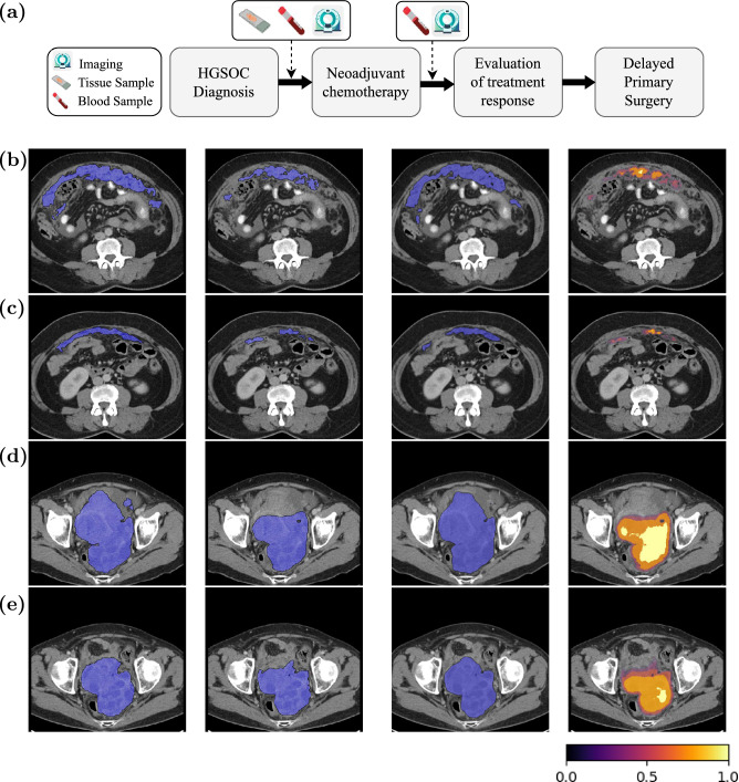 Multi-task deep learning for automatic image segmentation and treatment response assessment in metastatic ovarian cancer.