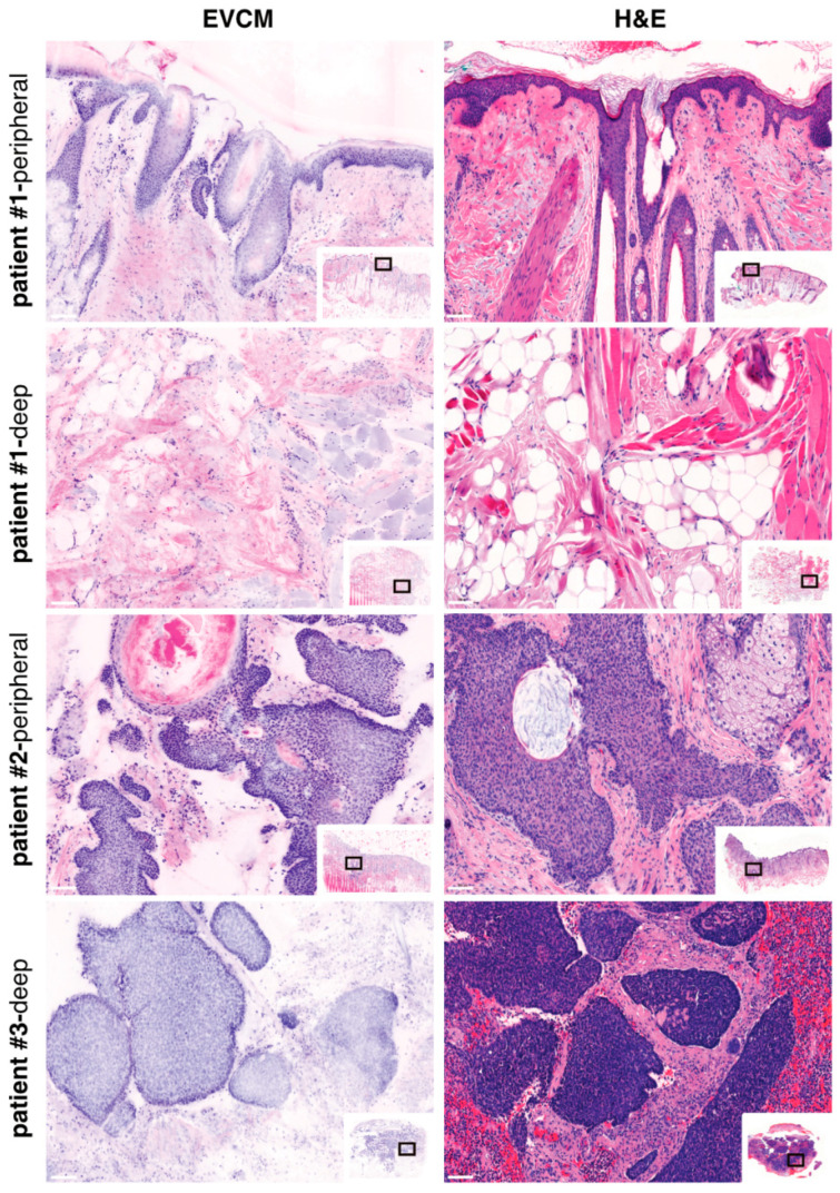 Diagnostic Accuracy of Ex Vivo Confocal Microscopy for Surgical Margin Assessment of High-Risk Nodular Basal Cell Carcinoma.