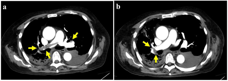 Pulmonary Embolism Associated with Olaparib in <i>BRCA2</i>-Mutated Prostate Cancer: A Case Report.