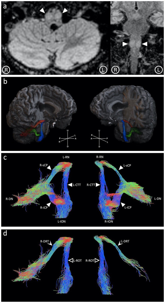 Hypertrophic olivary degeneration: a 7 Tesla advanced imaging case report.