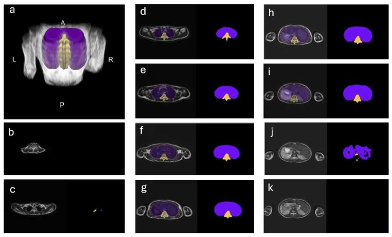 Quantification of Thoracic Volume and Spinal Length of Pediatric Scoliosis Patients on Chest MRI Using a 3D U-Net Segmentation.