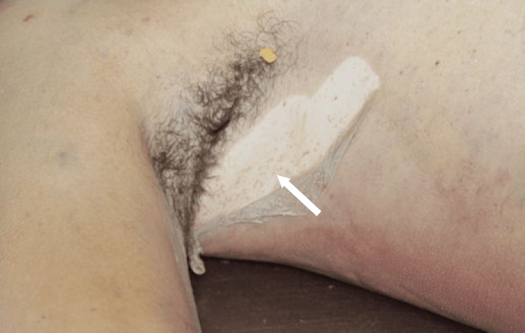 Fatal fat embolism syndrome in a young trauma patient with a stable initial presentation: time to define predictive criteria? A case report.