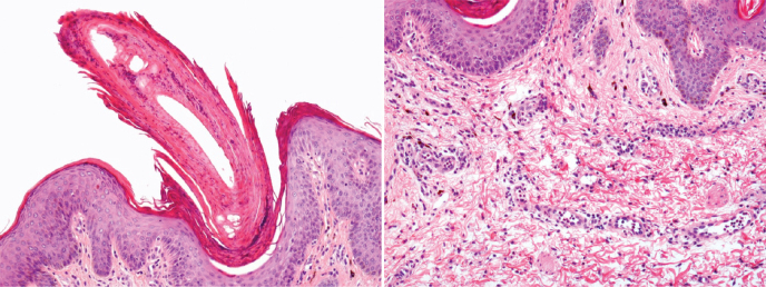 Cutaneous Graft-Versus-Host Disease Lichen Spinulosus-like: a New Form of Presentation of an Old Entity.