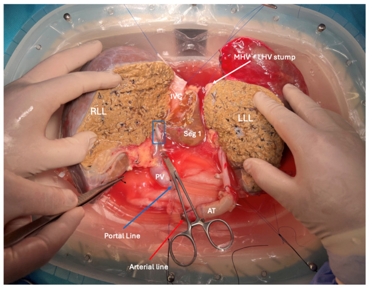Ex-Situ Dual Hypothermic Oxygenated Machine Perfusion in Full-Left-Full-Right Split Liver Transplantation for Two Adult Recipients.