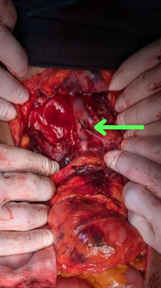Inferior vena cava injuries at a level I trauma center: a case series.