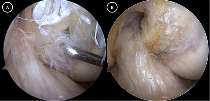 Case Report: Simultaneous mucoid degeneration of the ACL and PCL in a 62-year-old man: an under-recognized diagnostic pitfall.