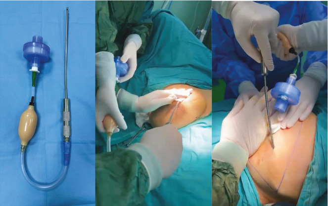 Air-Assisted Mastectomy Using LigaSure for a Breast Cancer Patient With a Cardiac Pacemaker.
