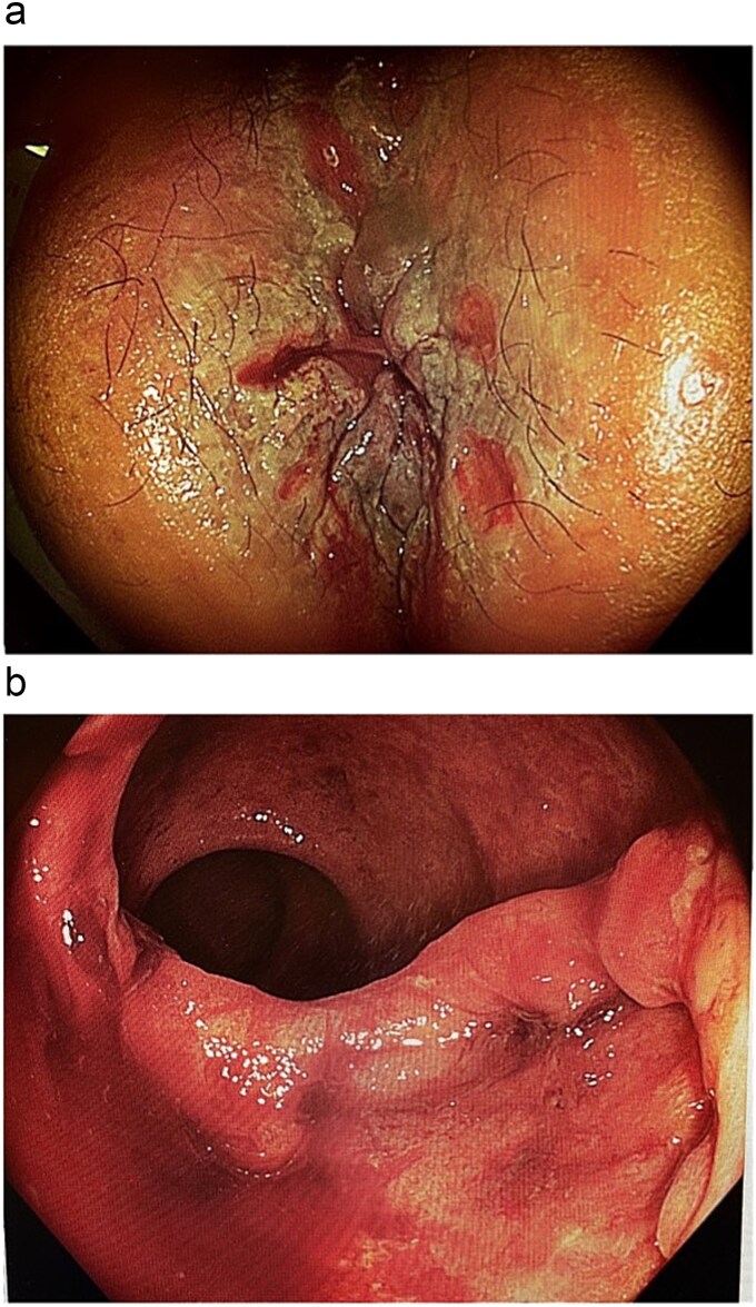 Late human immunodeficiency virus presenting as necrotizing anal ulceration due to cytomegalovirus.