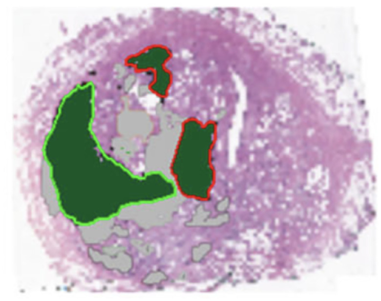 Ising energy model for the stochastic prediction of tumor islets.