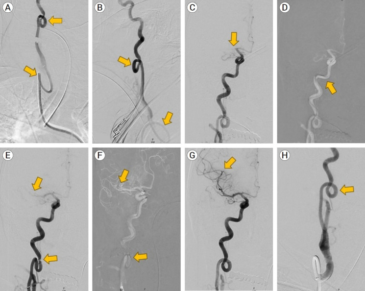 Navigating severe vascular tortuosity and cervical carotid loop management in stroke thrombectomy: A case report and review of the literature.
