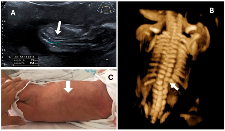 Long-Term Outcomes of Prenatally Diagnosed Fetal Hemivertebra: A 15-Year Single-Center Review.