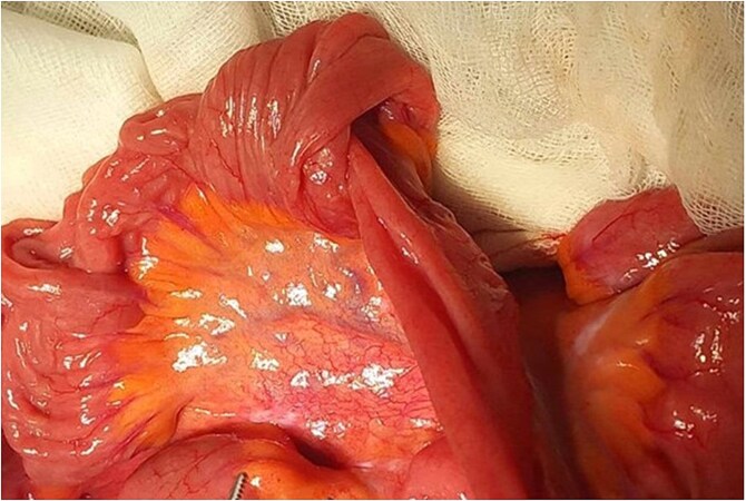 Jejunal lipoma presenting as small bowel intussusception in an adult: diagnostic and surgical challenges-a case report.