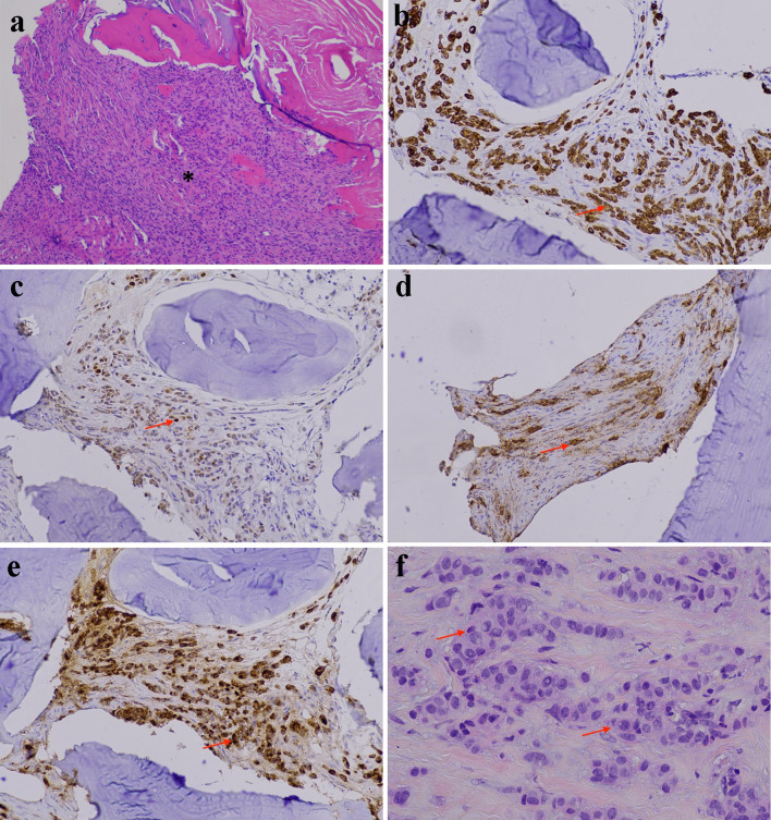 Acute Hepatitis in a Patient Treated With Ribociclib for Metastatic Breast Carcinoma.