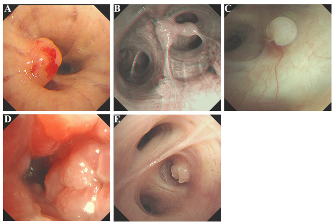 CT-Occult Primary Benign Tracheobronchial Neoplasms: A Single-Center 40-Case Clinicopathologic Series.