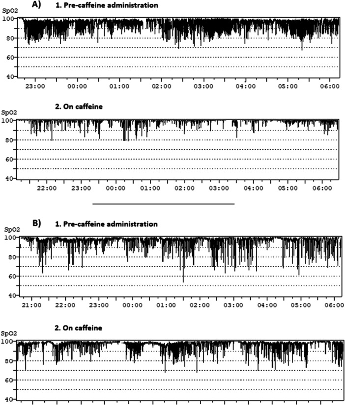 Caffeine for Persistent Intermittent Hypoxia in Newborns With and Without Chronic Lung Disease.
