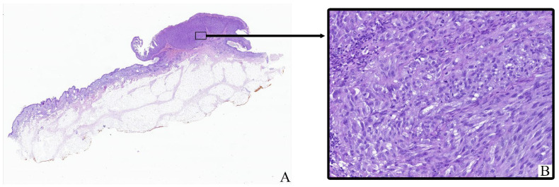 Phenotypic and Quantitative Characterization of Mast Cells in Cutaneous Melanoma: Correlation with Staging Metrics.