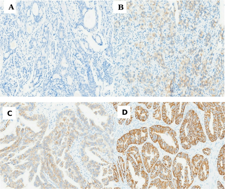 Human epidermal growth factor receptor 2 expression and socio-demographic, clinical, and histopathological characteristics in gastric carcinoma at St Francis Hospital Nsambya, Uganda.