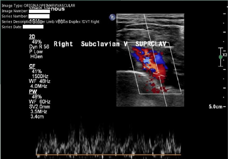 An Unusual Presentation of Paget-Schroetter Syndrome: A Reminder on the Importance of Clinical Judgment.