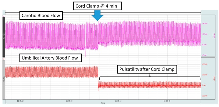 The Utility of Umbilical Cord Pulse Oximetry-A Translational Study with Four Minutes of Deferred Cord Clamping Using an Asphyxiated Preterm Ovine Model.