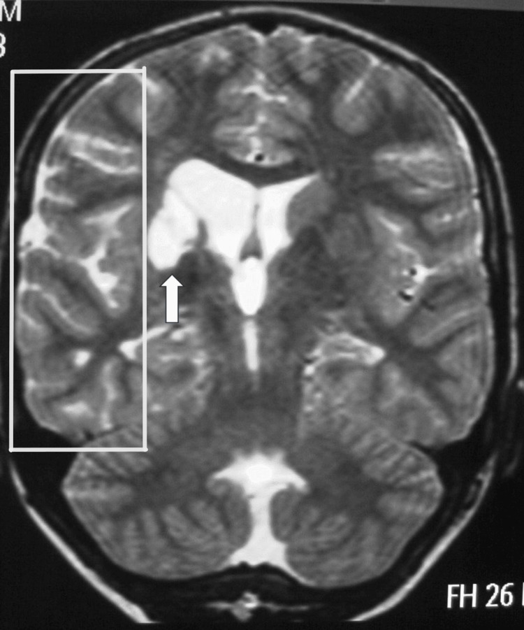Moyamoya Disease in Pregnancy: A Case Report and Review of the Literature.