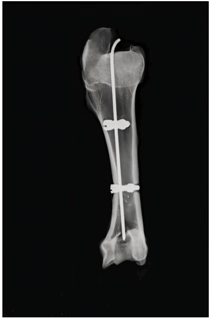 Original Locking Rod System Designed for Diaphyseal Fractures of Long Bones.