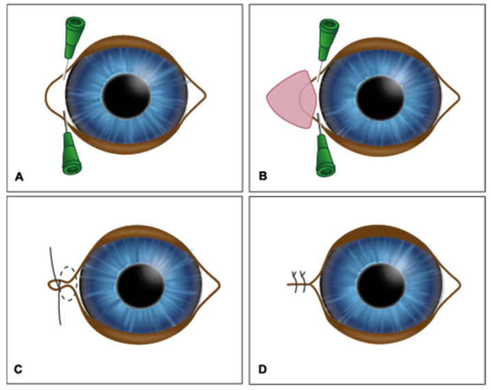 Effects of Canthoplasty in Preventing Secondary Ocular Surface Lesions in Brachycephalic Dogs.