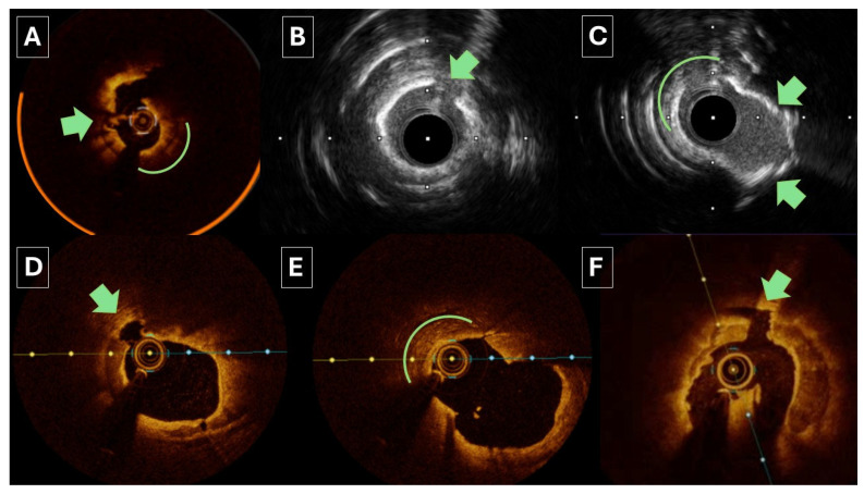The Role of Orbital Atherectomy for Complex Coronary Calcium Modification: Has It Been Eclipsed?