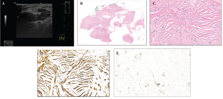 Pseudoangiomatous Hyperplasia of Mammary Stroma: Insights from Two Cases, Data Update and Management Algorithm.