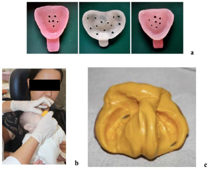 Expanding Access to Presurgical Cleft Care: Digital Nasoalveolar Molding with Clear Aligners in a Rural Low-Income Population.