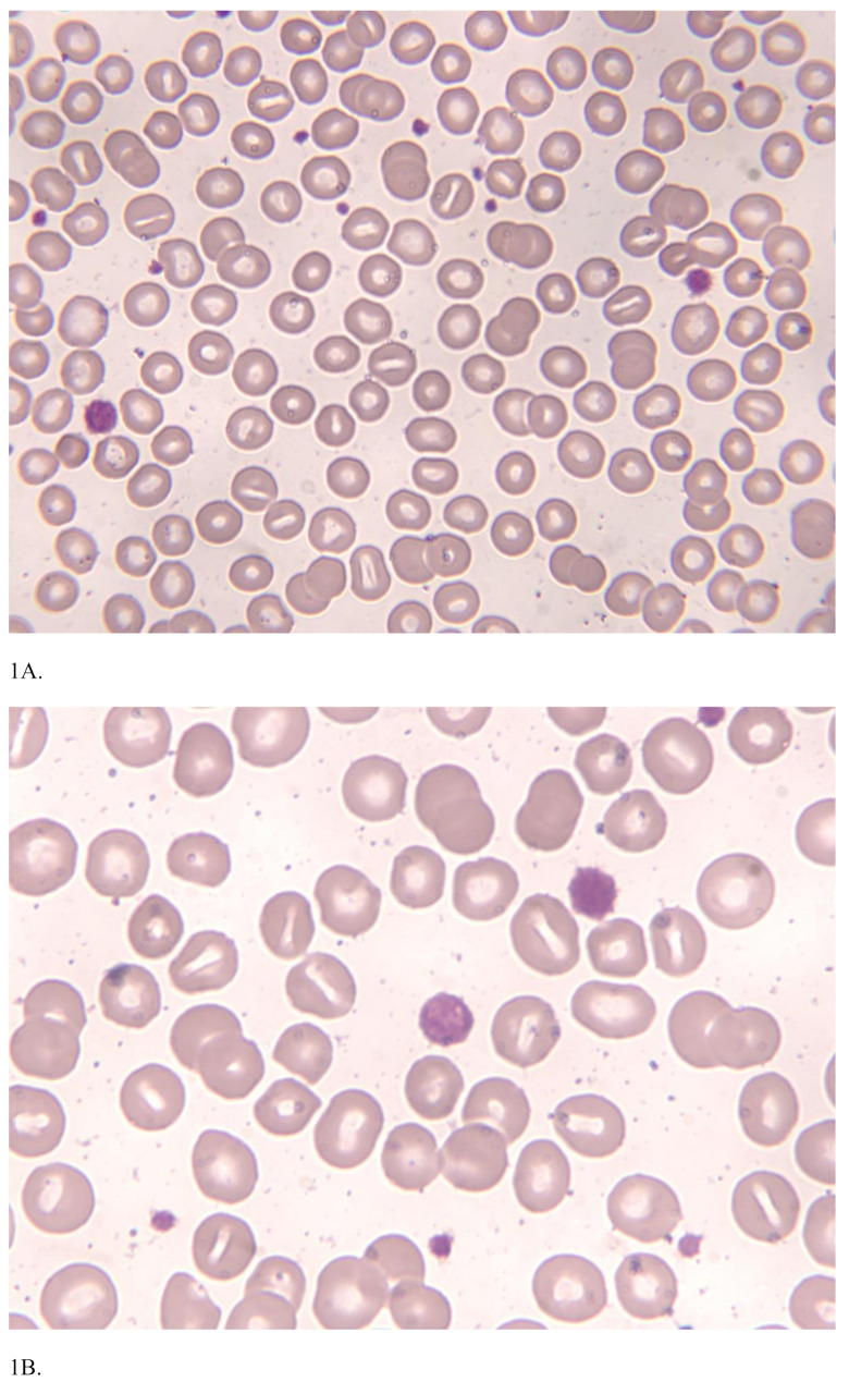 From Bernard-Soulier syndrome to sitosterolemia: the role of genetic analysis in bleeding diathesis.