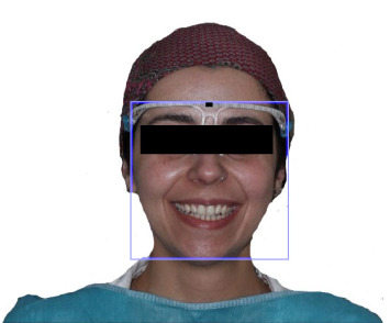 Evaluating Canine Positioning Relative to Facial Landmarks: A Study on the Accuracy of the Inner Canthus and Alar of the Nose as Reference Points.